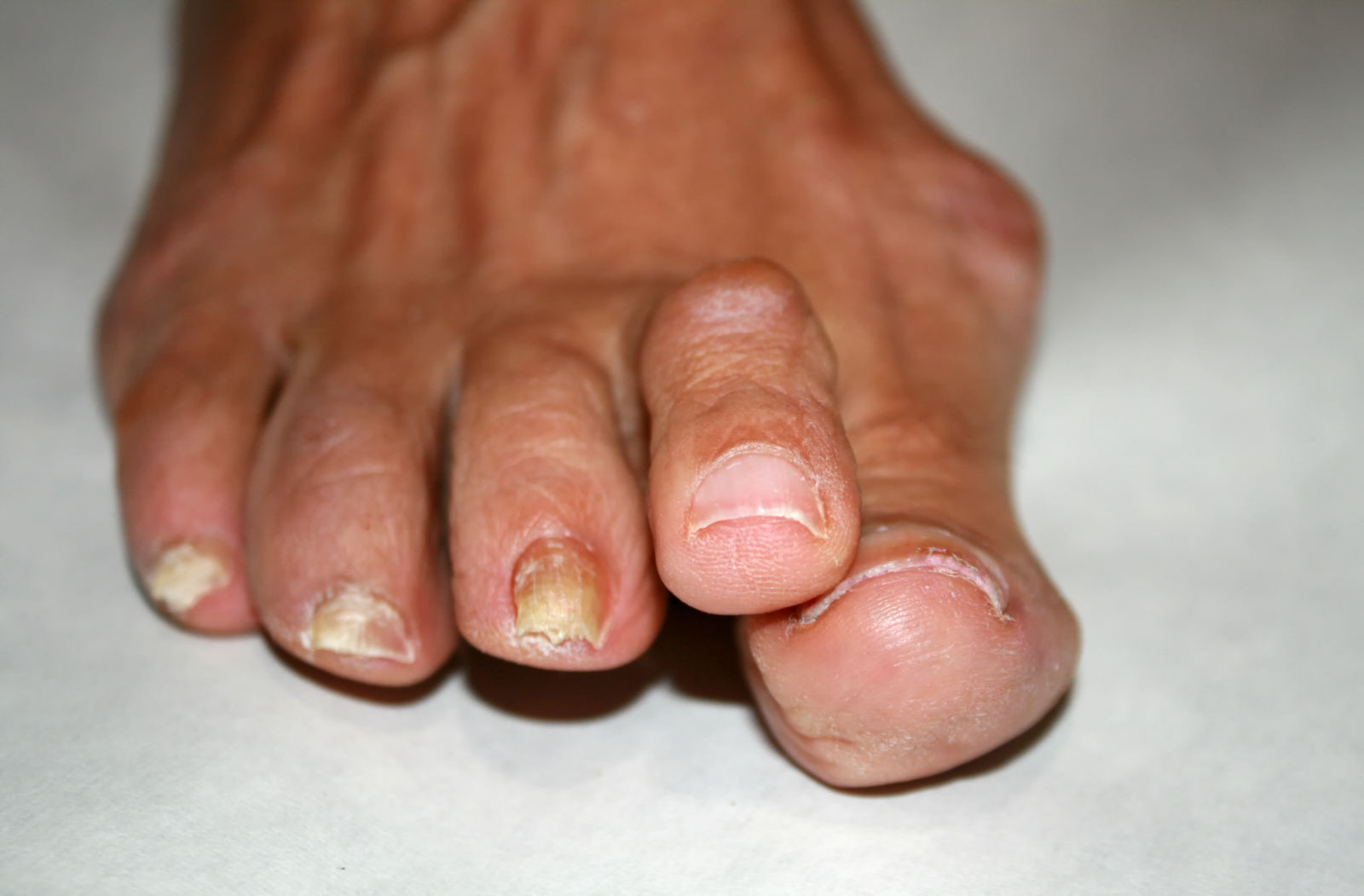 Reumatische voeten