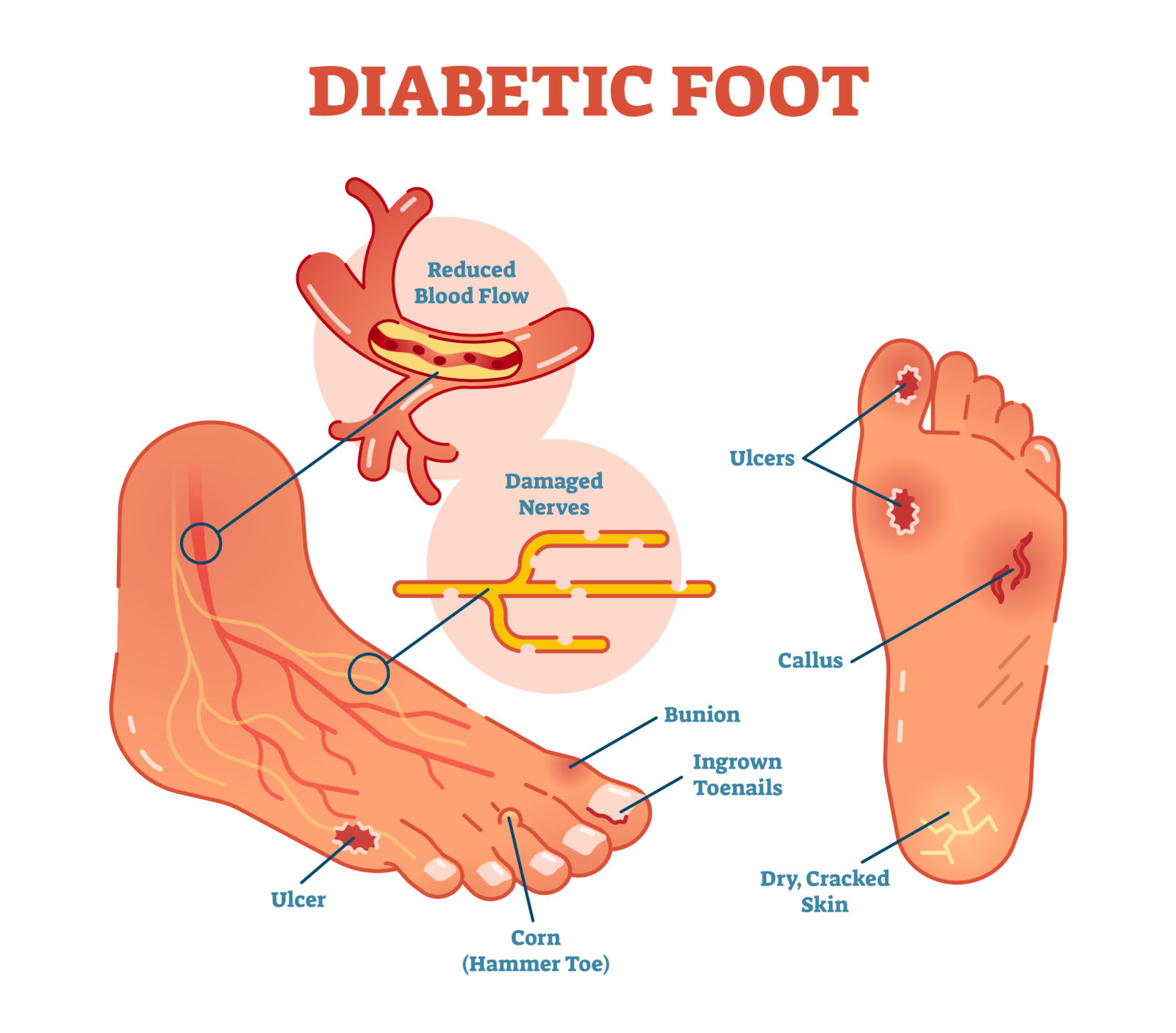 Voetverzorging bij diabetes